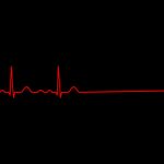 EKG_End